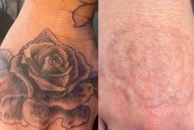 تاتو ریموال