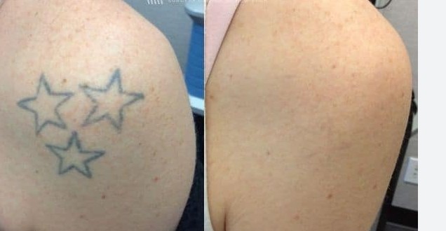 تاتو ریموال 2